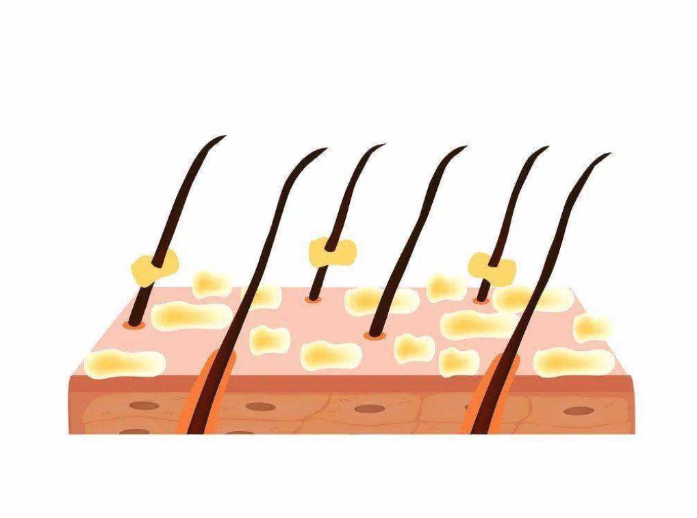 无硅油配方换汤不换药，阳离子调理剂正在危害头皮健康