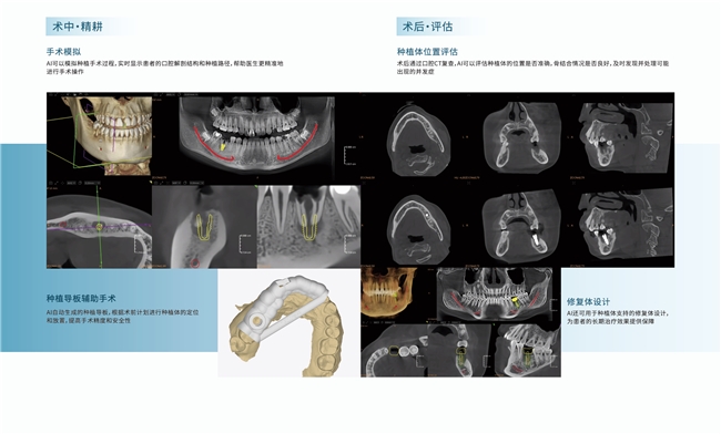 实测对比:传统CT vs 智能CT,导板设计差在哪? 实测对比:传统CT vs 智能CT,导板设计差在哪?
