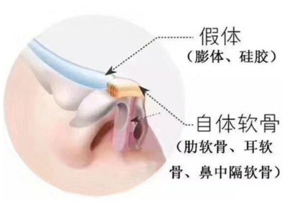 几年前，高翘直挺的网红鼻走进大众的视野，一度成为女孩们隆鼻的首选鼻型。如今，“妈生鼻”成为隆鼻的…