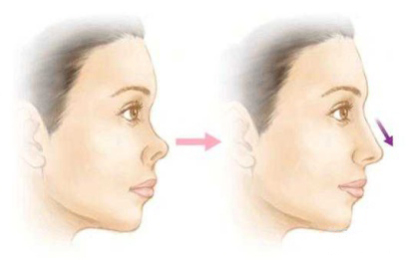 几年前，高翘直挺的网红鼻走进大众的视野，一度成为女孩们隆鼻的首选鼻型。如今，“妈生鼻”成为隆鼻的…