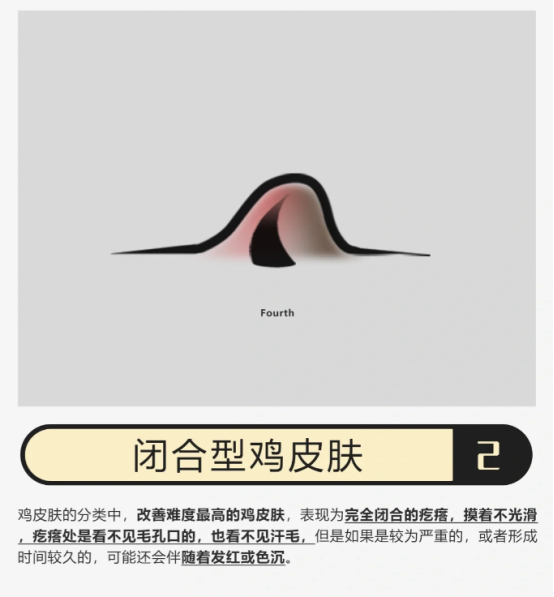 你是哪种鸡皮肤？找对方法成功上岸！