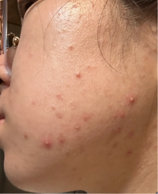 青春痘有什么危害，家长们要注意了，不仅仅是影响面部