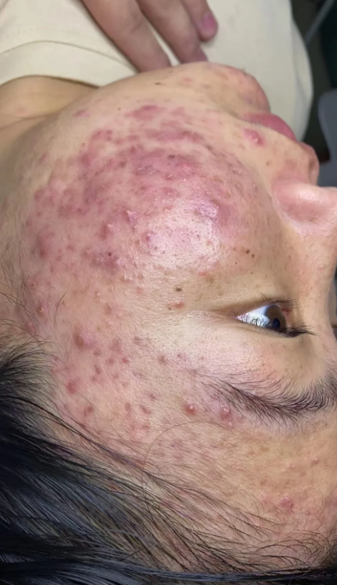 青春痘有什么危害，家长们要注意了，不仅仅是影响面部