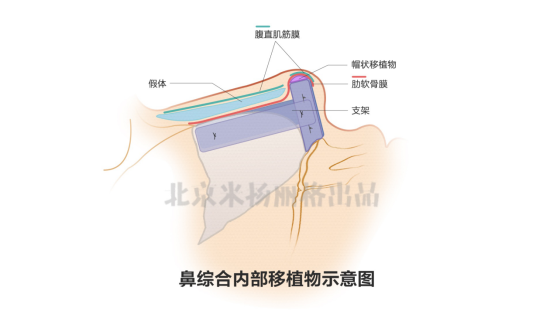 巫文云院长论文《自体肋软骨改善鼻尖形态的效果》发表于国家学术期刊上