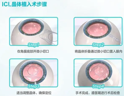 眼科员工告诉你?ICL晶体手术大实话