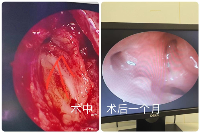 八旬老人“泪眼婆娑”！普瑞眼科微创泪道手术解其忧