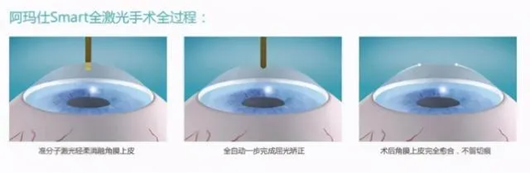 2024 高考临近，大数据请推给考后想做近视手术的高三学生们