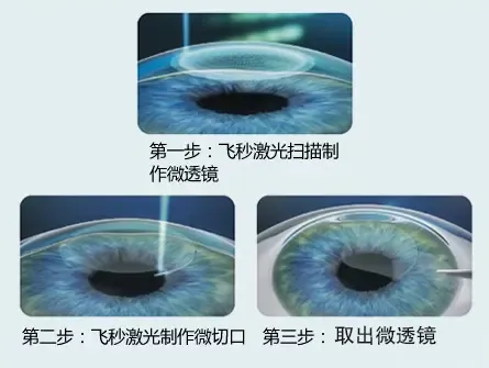 2024 高考临近，大数据请推给考后想做近视手术的高三学生们