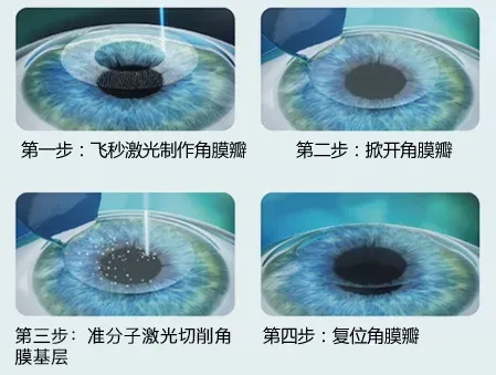 2024 高考临近，大数据请推给考后想做近视手术的高三学生们