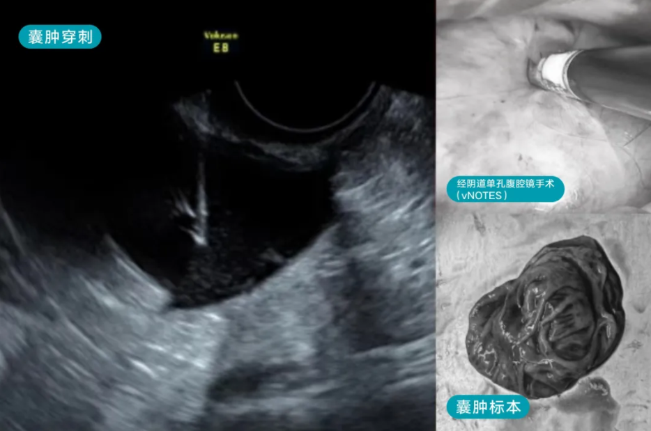 龚晓明教授的妙手“针”心，穿刺治疗卵巢囊肿