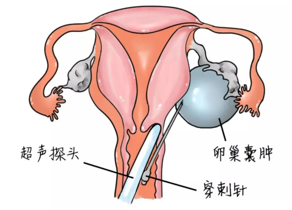 龚晓明教授的妙手“针”心，穿刺治疗卵巢囊肿