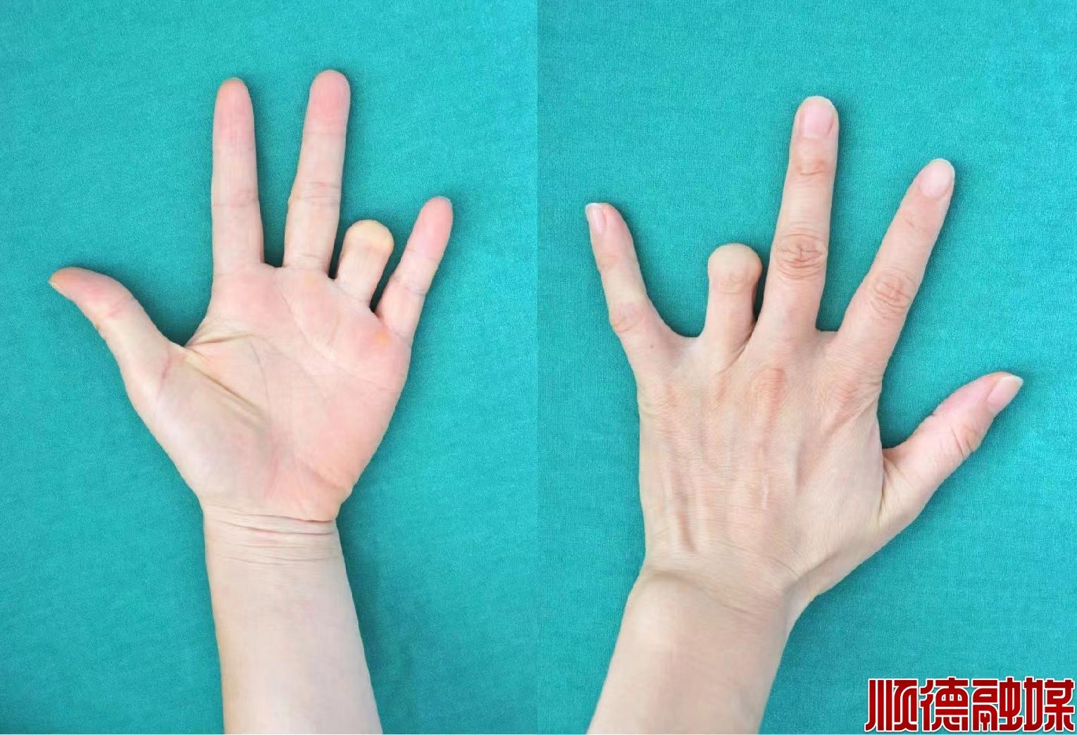 手指离断千里求医,这家医院手足外科将断指再植成功 