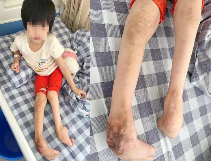 先天性马蹄内翻足患儿救助启动