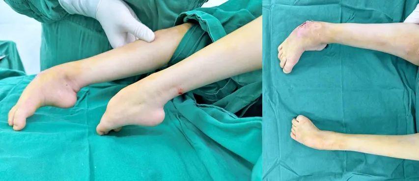 先天性马蹄内翻足患儿救助启动