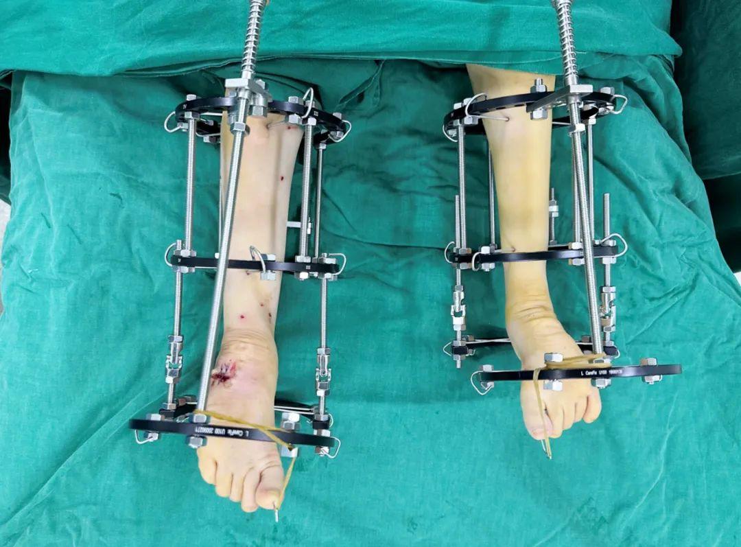 先天性马蹄内翻足患儿救助启动