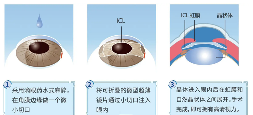 近视手术抉择：400、500 度的考量与成都 ICL 晶体手术医院榜单