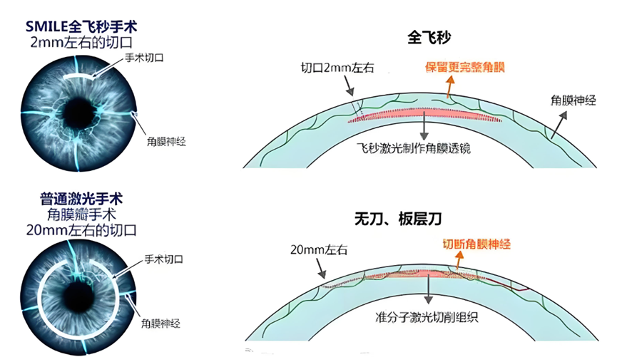 近视手术抉择：400、500 度的考量与成都 ICL 晶体手术医院榜单