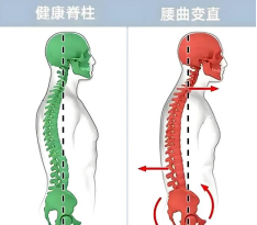 腰间盘突出症的重要干货——腰腿疼痛伴下肢麻木...