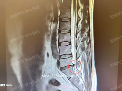 腰间盘突出症的重要干货——腰腿疼痛伴下肢麻木...