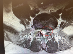 腰间盘突出症的重要干货——腰腿疼痛伴下肢麻木...