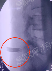 腰间盘突出症的重要干货——腰腿疼痛伴下肢麻木...