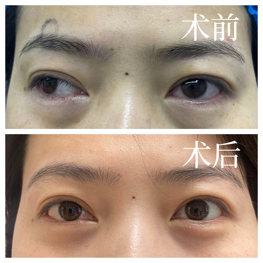 通江护士22年斜视困扰一朝解除 成都普瑞眼科杨英医生助其重拾自信