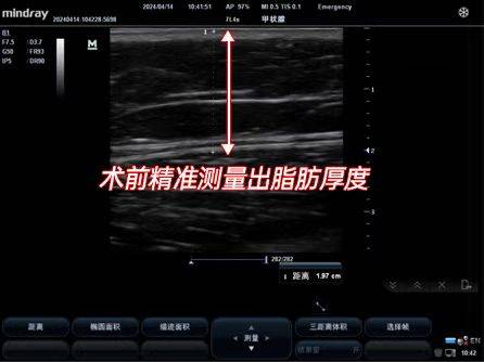 知名脂肪专科汪峰院长亮相第十三届全国微创医美大会，深度分享可视化吸脂新进展