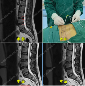 腰椎间盘突出症该如何治疗？三个顺德和平愈案告诉你答案