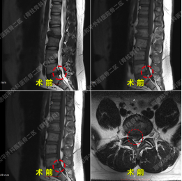 腰椎间盘突出症该如何治疗？三个顺德和平愈案告诉你答案