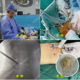 腰椎间盘突出症该如何治疗？三个顺德和平愈案告诉你答案