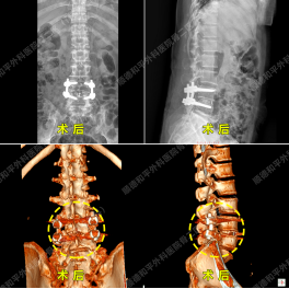 腰椎间盘突出症该如何治疗？三个顺德和平愈案告诉你答案