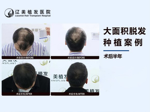 沈阳大面积重度脱发植发怎么做?辽美植发本地老牌机构,科学规划毛囊资源 沈阳大面积重度脱发植发怎么做?辽美植发本地老牌机构,科学规划毛囊资源