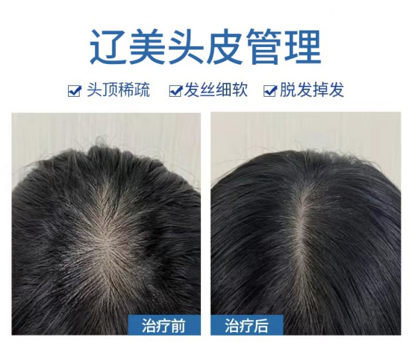 沈阳植发后怎么平稳度过恢复期？沈阳辽美植发，分阶段养护指南