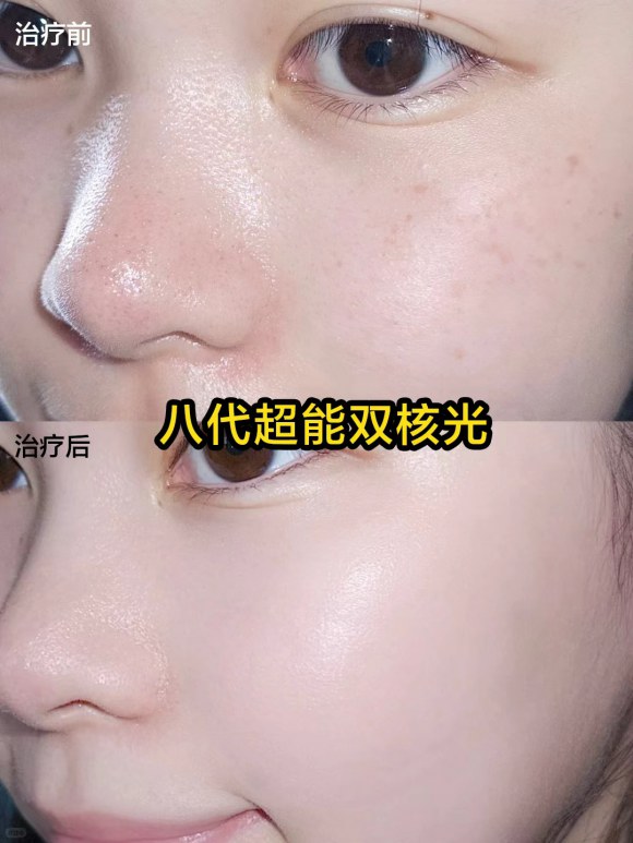台州维多利亚刘松超能双核光怎么样?联合仪器改善复合问题肌 台州维多利亚刘松超能双核光怎么样?联合仪器改善复合问题肌